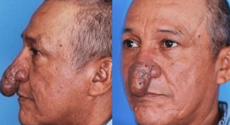 The Remarkable Transformation of Conrado’s Nose