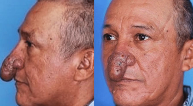 The Remarkable Transformation of Conrado’s Nose