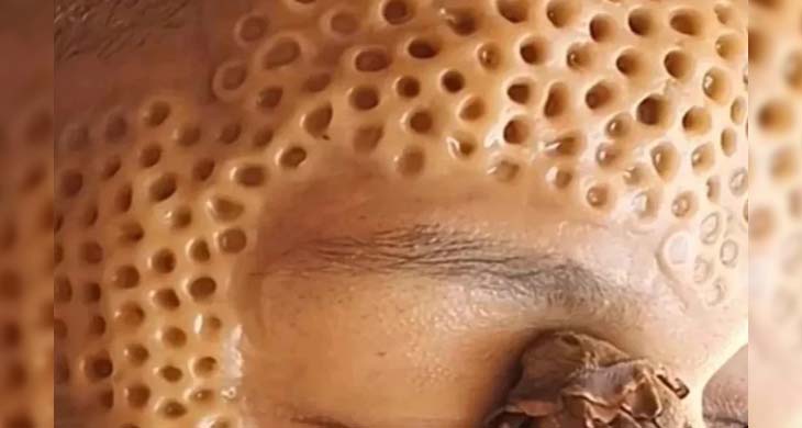Forehead Acne