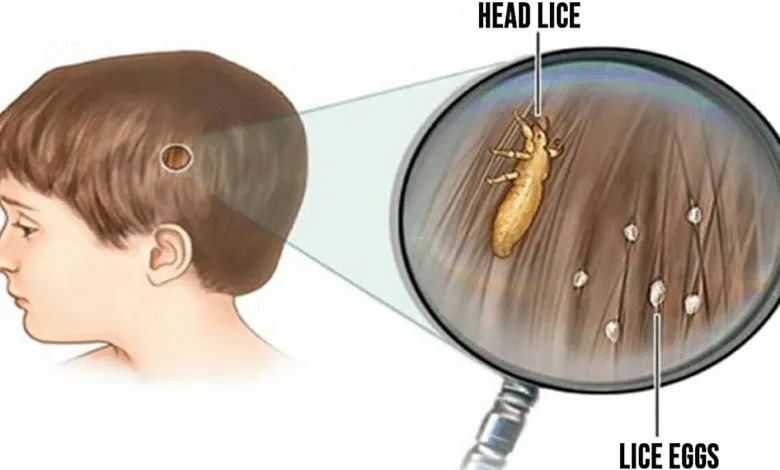 Head lice: How to get rid of them and stop them