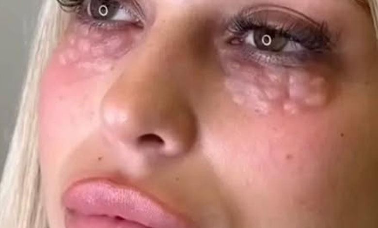 Doctors warn against beauty trend that causes